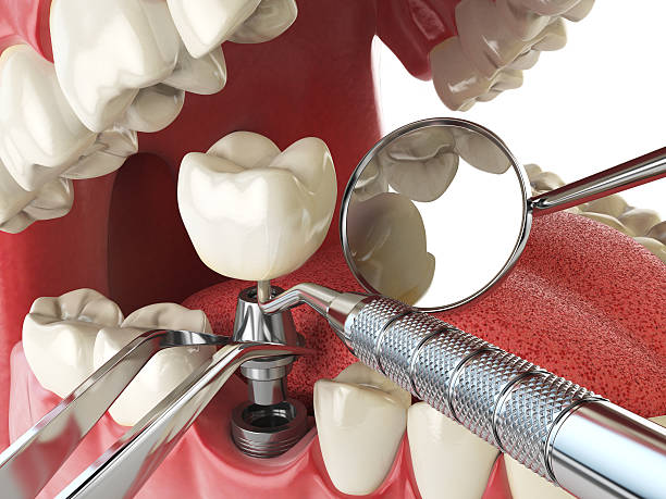 Best Emergency Root Canal Treatment in Newnan, GA